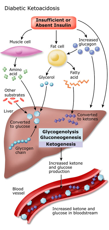 http://dtc.ucsf.edu/living-with-diabetes/complications/diabetic-ketoacidosis/